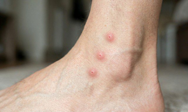 piqûre punaise de lit sur la cheville