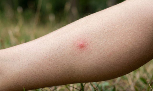 piqûre de moustique