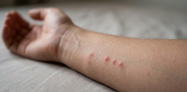 piqûre de punaises de lit