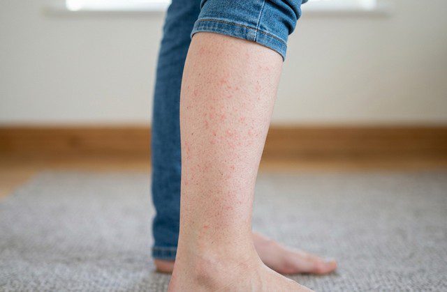 allergie acarien sur la jambe