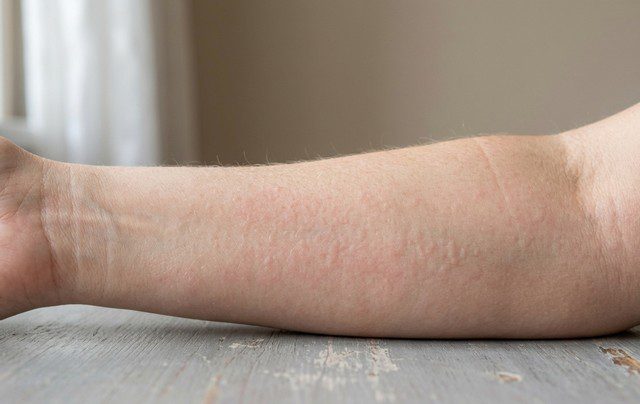 allergie acarien sur le bras