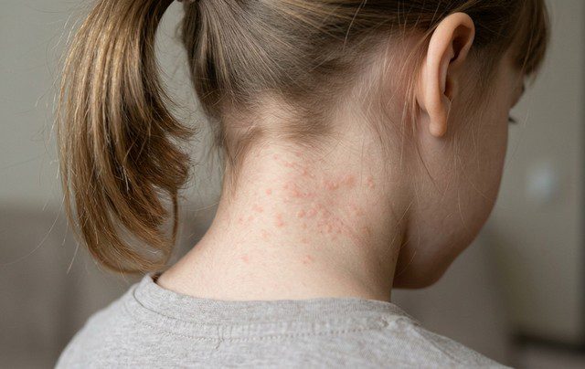 allergie acarien sur un enfant